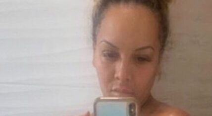 Kimbella post-surgery body LHHNY