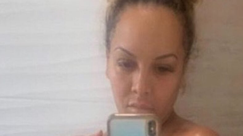 Kimbella post-surgery body LHHNY
