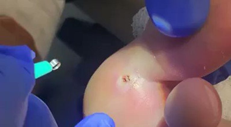 Man complained about a splinter in his foot but it turns out it was a toothpick