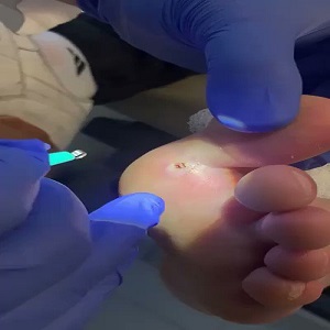 Man complained about a splinter in his foot but it turns out it was a toothpick