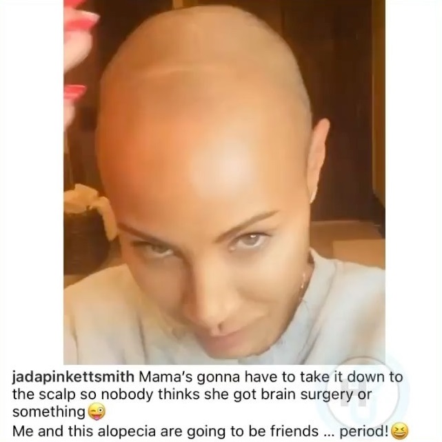 Jada Pinkett Smith reveals she has alopecia
