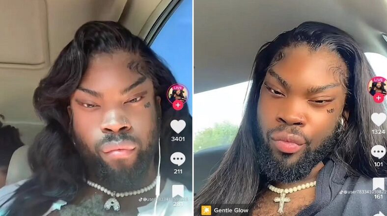 Man goes viral after getting slanted eye surgery