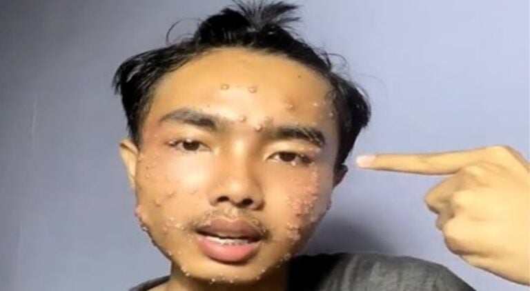 A popular TikToker reveals he got a skin infection from wearing thrifted clothes.